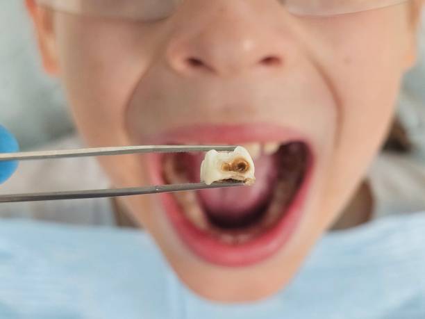 Best Emergency Dental Care for Abscessed Tooth in Braddock Heights, MD